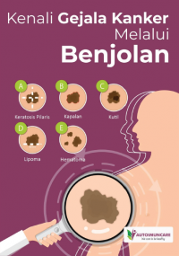 Kenali Gejala Kanker Melalui Benjolan